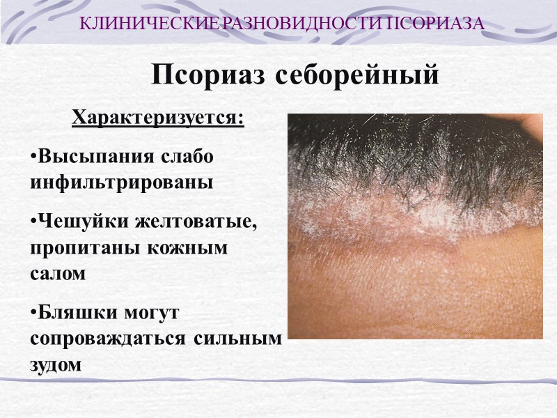 Псориаз себорейный Локализация Волосистая часть головы Носогубные, носощечные, заушные складки Область груди Между лопатками